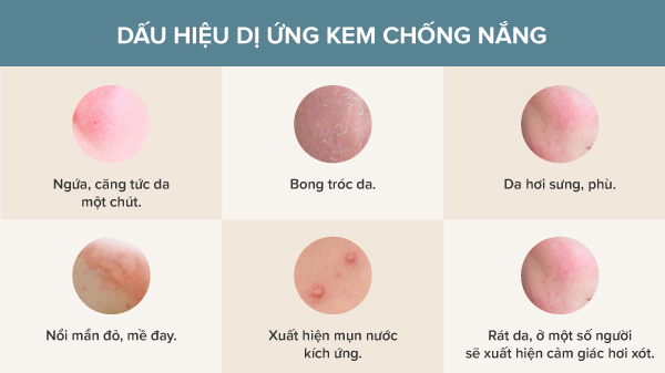 Nguyên Nhân Gây Ra Dị Ứng Kem Chống Nắng
