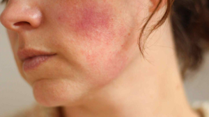Hướng Dẫn Xử Trí Khi Bị Dị Ứng