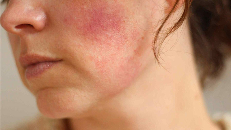 Hướng Dẫn Xử Trí Khi Bị Dị Ứng